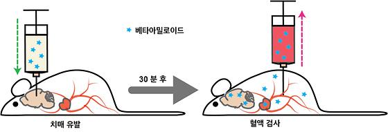 복잡한 검사없이 혈액 한방울로 알츠하이머 치매를 진단하다