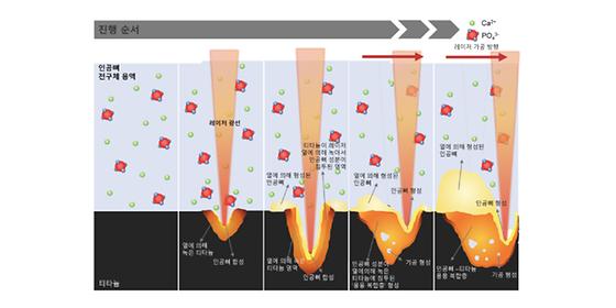 임플란트에 인공뼈 코팅해서 염증 해결한다