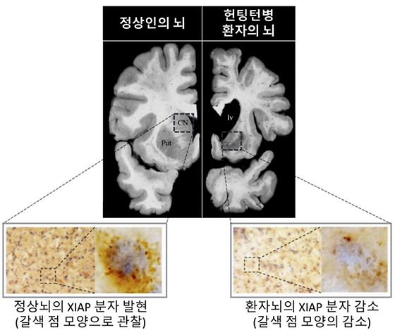 헌팅턴병 환자의 뇌조직에서 세포 손상 원리 발견